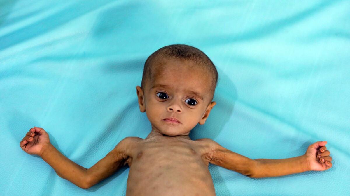 A Yemeni child suffering from malnutrition lies in a bed at a treatment centre in the country's third-city of Taez, on October 28, 2020.