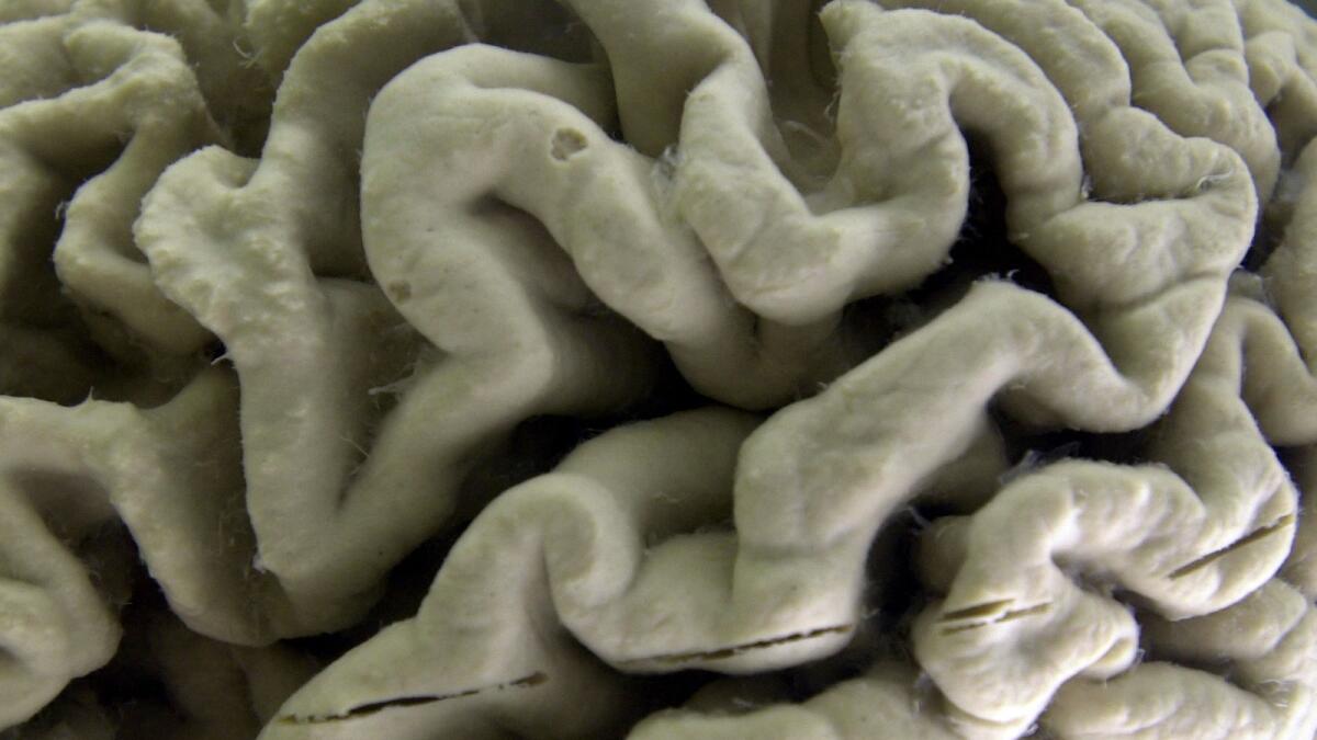 This Oct. 7, 2003 file photo shows a closeup of a human brain affected by Alzheimer's disease, on display at the Museum of Neuroanatomy at the University at Buffalo in New York.  — AP