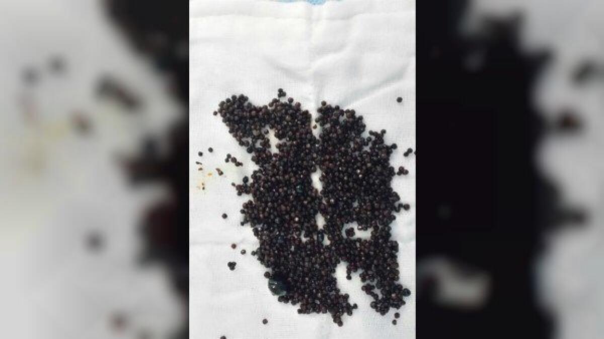1,600 gallstones removed from Emirati woman